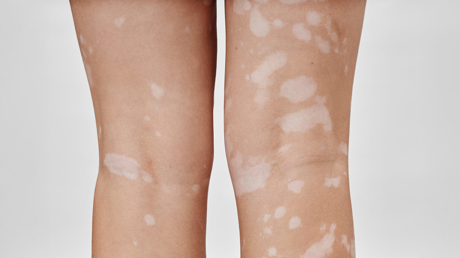 Vitiligo Dermatology Clinics Australia