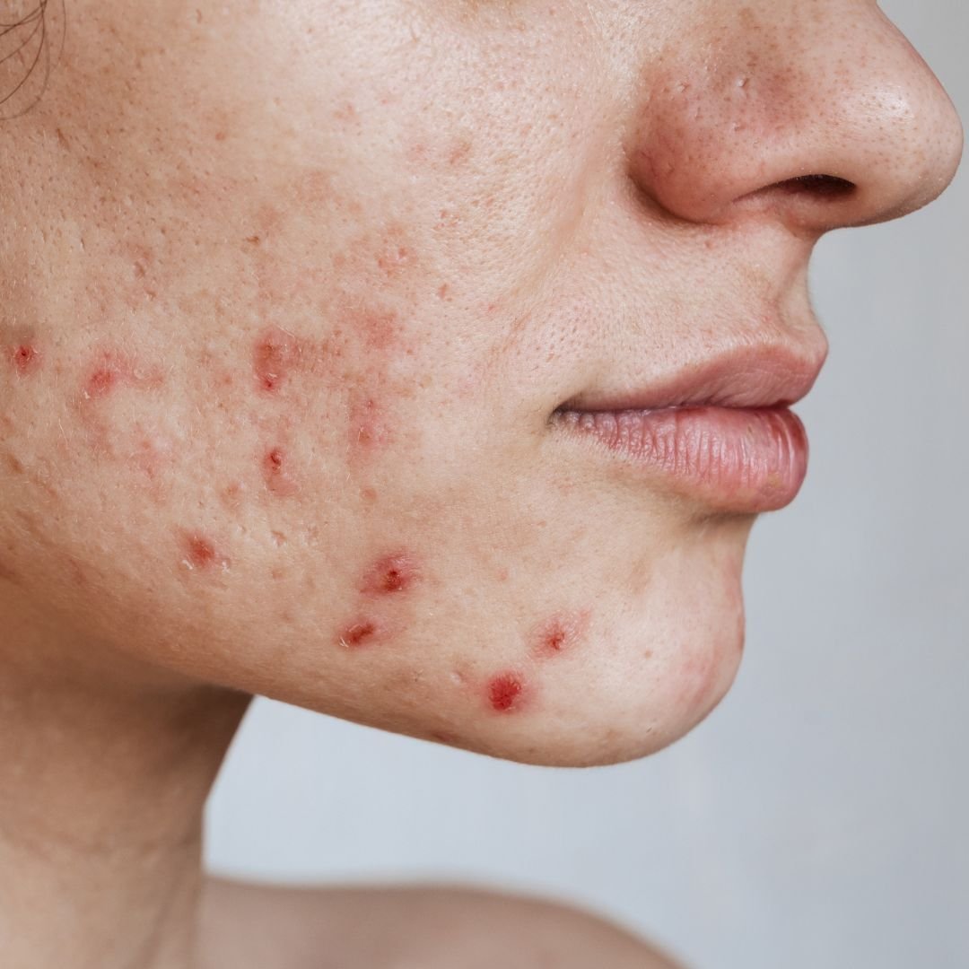 acne