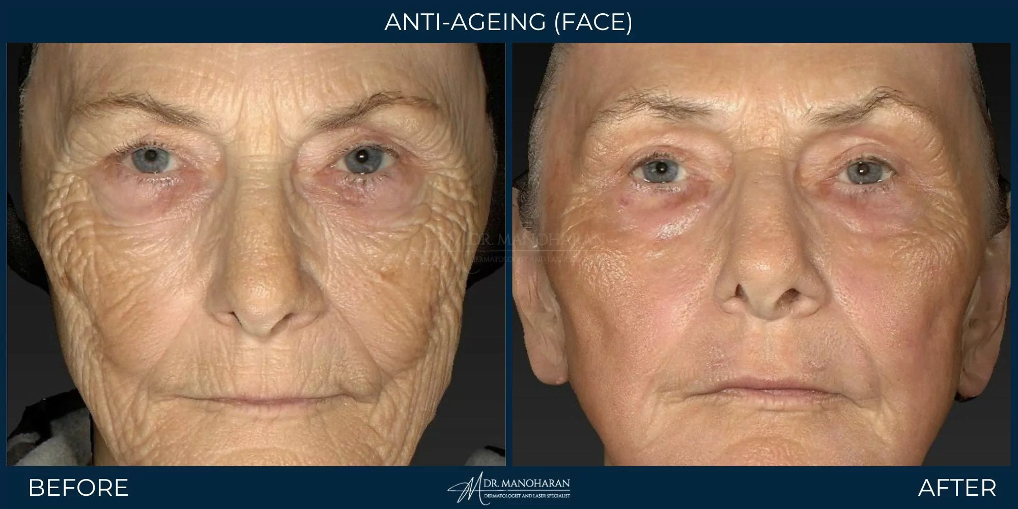 anti-ageing treatment